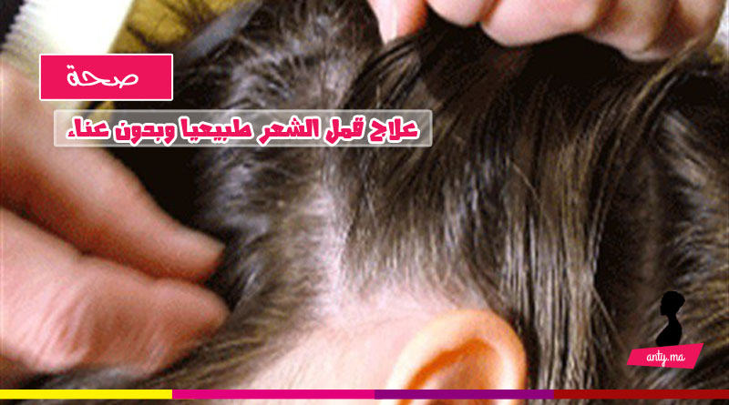 علاج قمل الشعر طبيعيا وبدون عناء